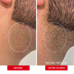 First Aid Beauty ingrown hair pads underarms area ideal for post-shave skin care.