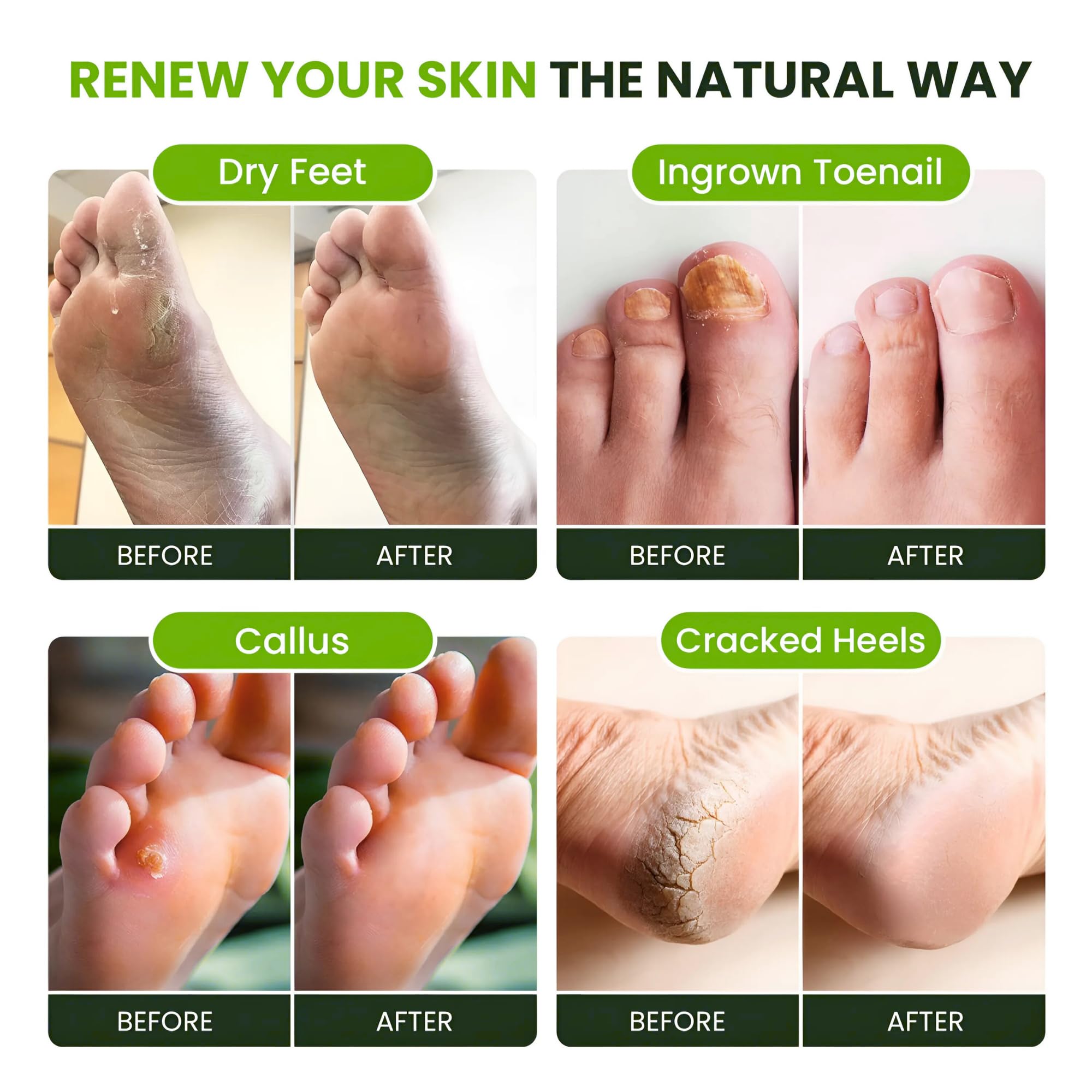 Foot Cure Tea Tree Oil Foot Soak odor elimination for fresher feet