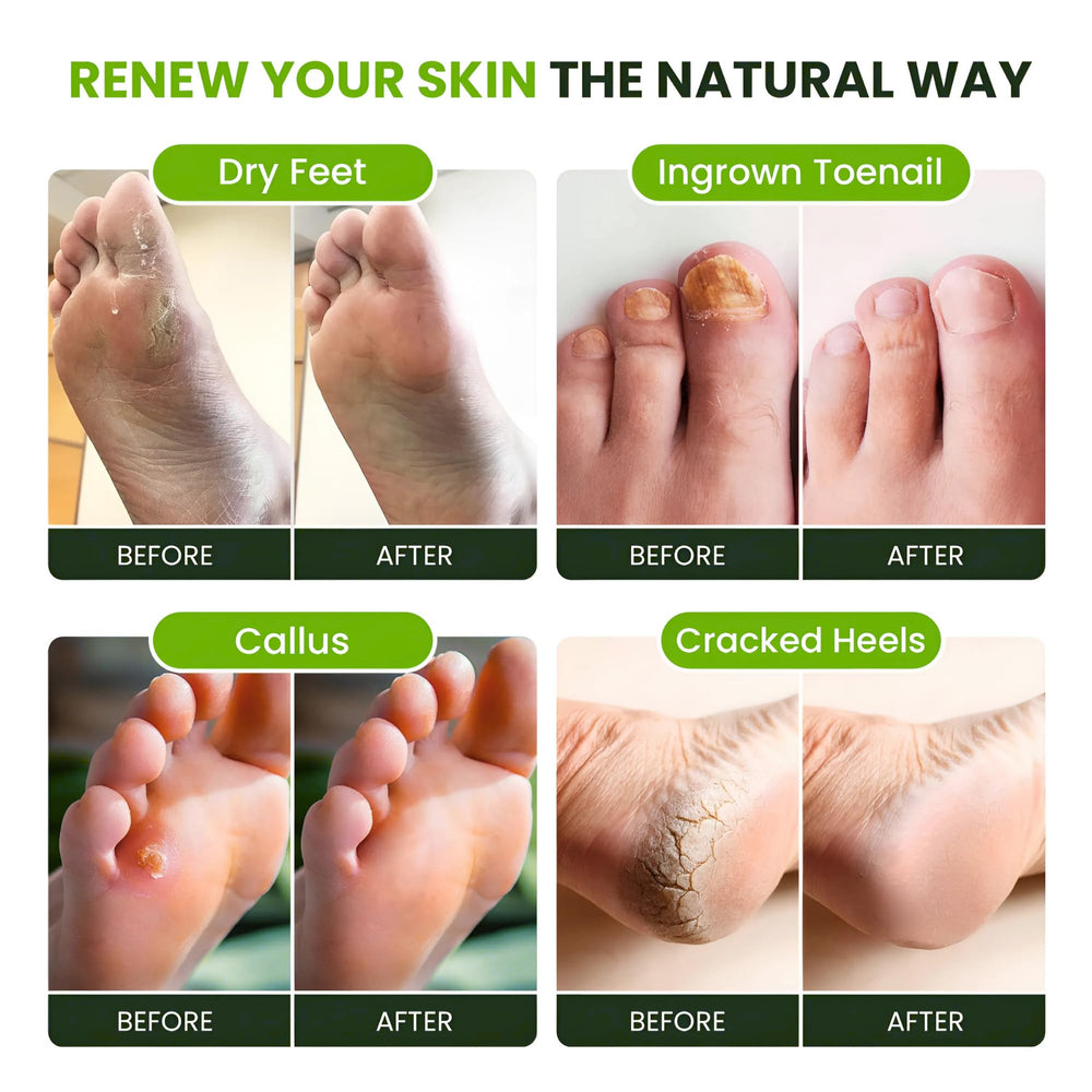 Foot Cure Tea Tree Oil Foot Soak odor elimination for fresher feet