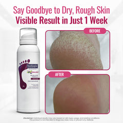 Application swirl of Footlogix mousse on foot surface for easy rub-in