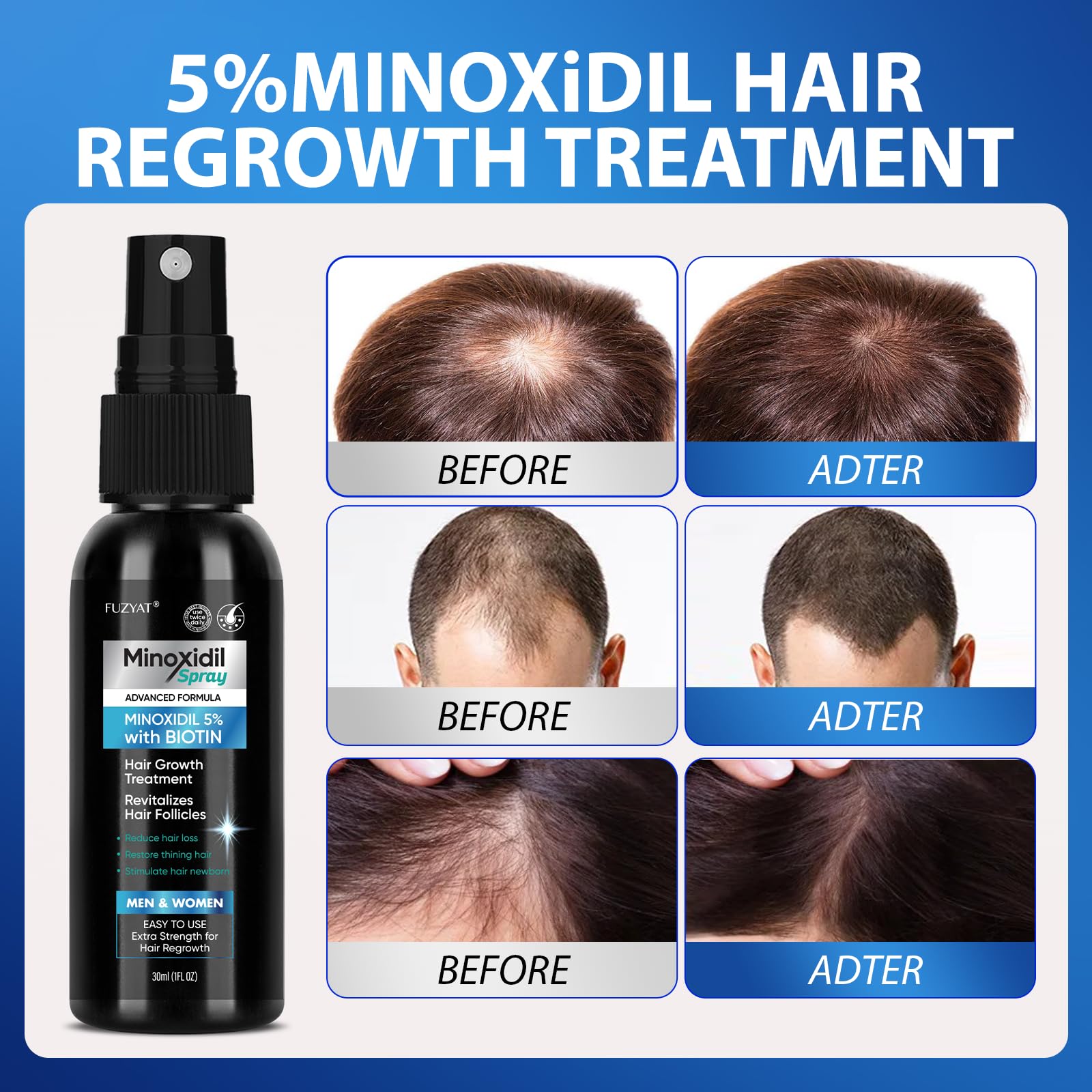 FUZYAT minoxidil spray ingredients Biotin Niacinamide for scalp nourishment