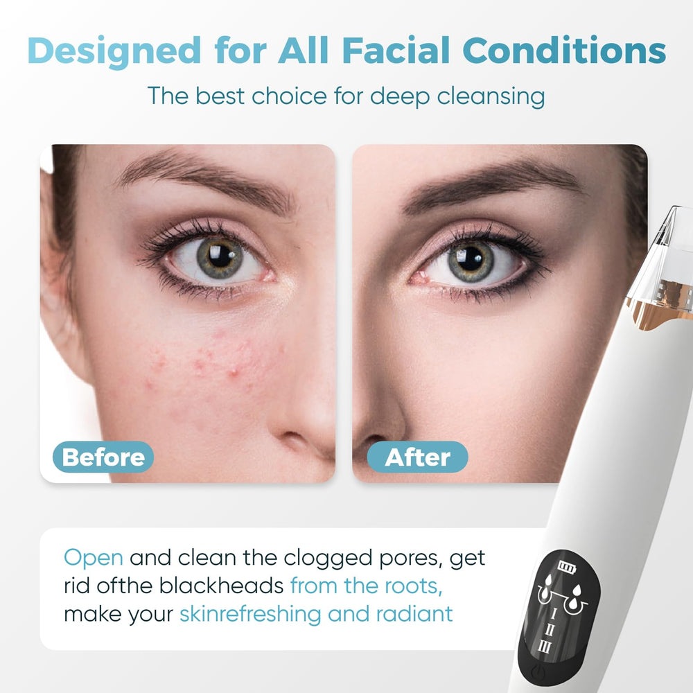Gacavks blackhead removal probe closeup highlights precision tip for targeted blackhead extraction