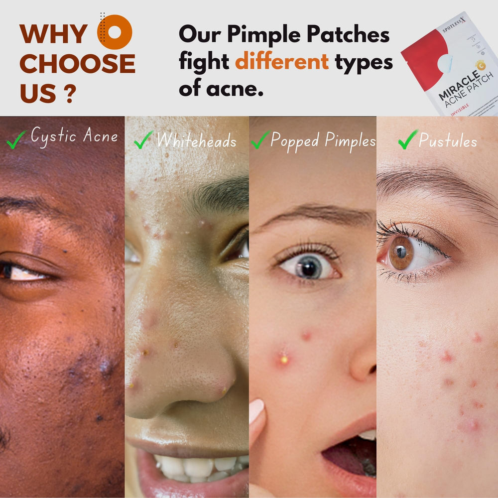 Generic salicylic-acid-closeup highlights pore-clearing action of patches.