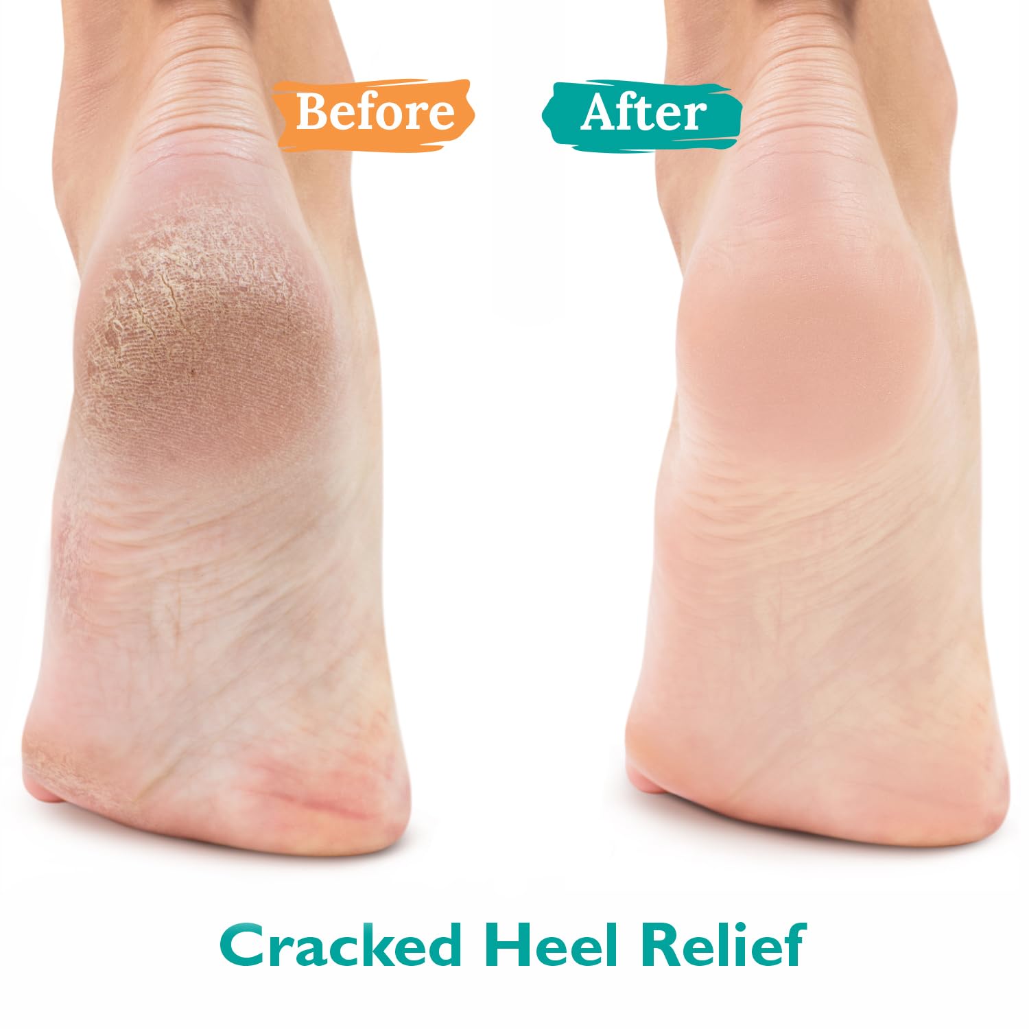 GILDEN TREE Urea Gel heel relief application demonstrates softening dry skin