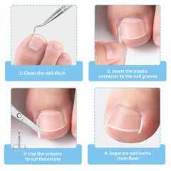 GJNL ingrown toenail strip adhesion applied for secure correction