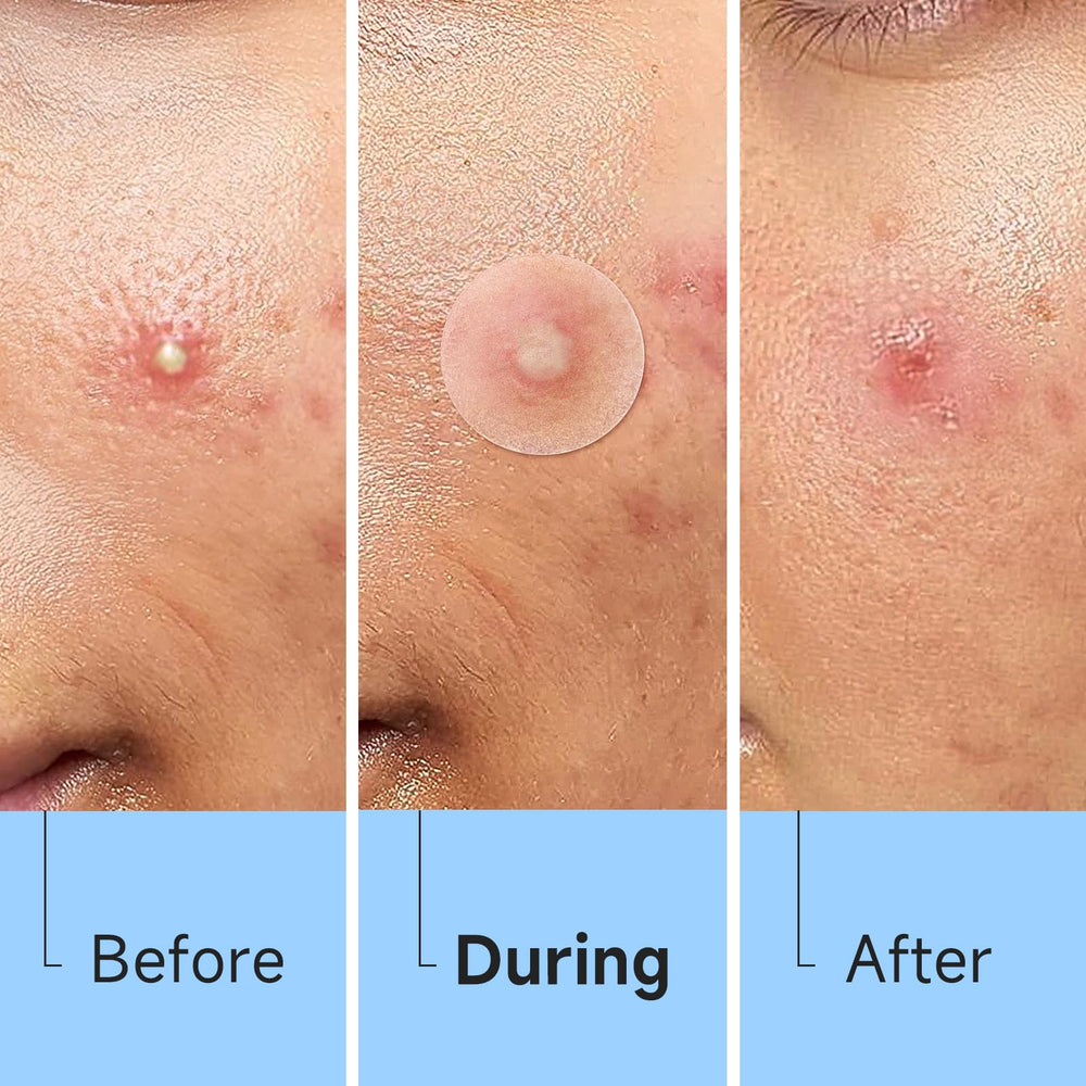 Glowpatch pimple patch on face demonstrates discreet, clear coverage