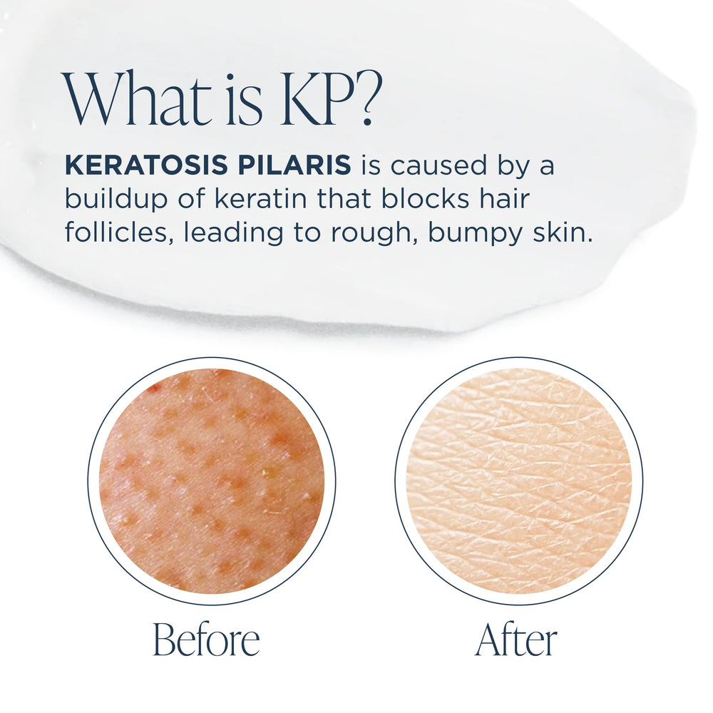 GLYTONE KP Kit skin texture closeup shows smoother surface potential