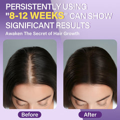 Greoay minoxidil foam pumps shown for targeted area application