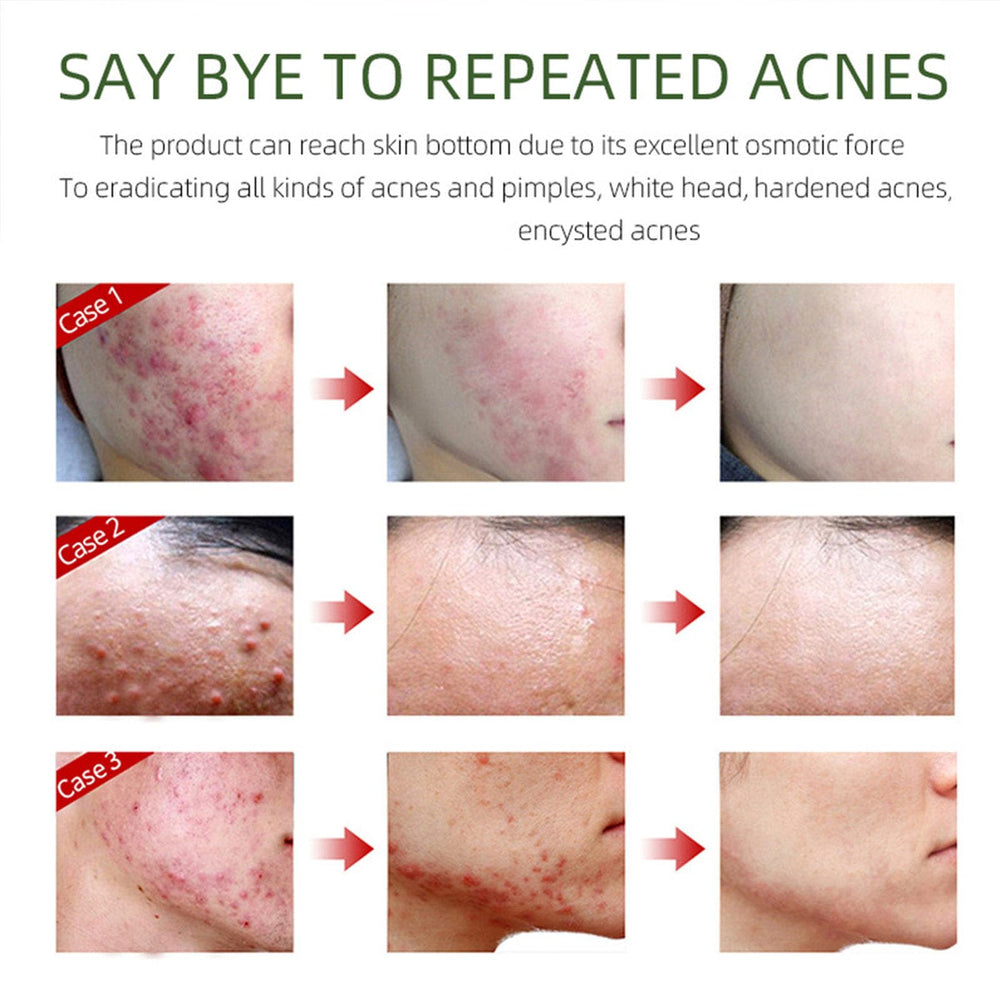 Grospe acne removing cream before after visuals hint blemish reduction.