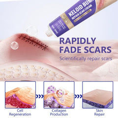 Hemir Keloid Bump Removal Cream application-spot demonstrates smooth fingertip glide for daily use.