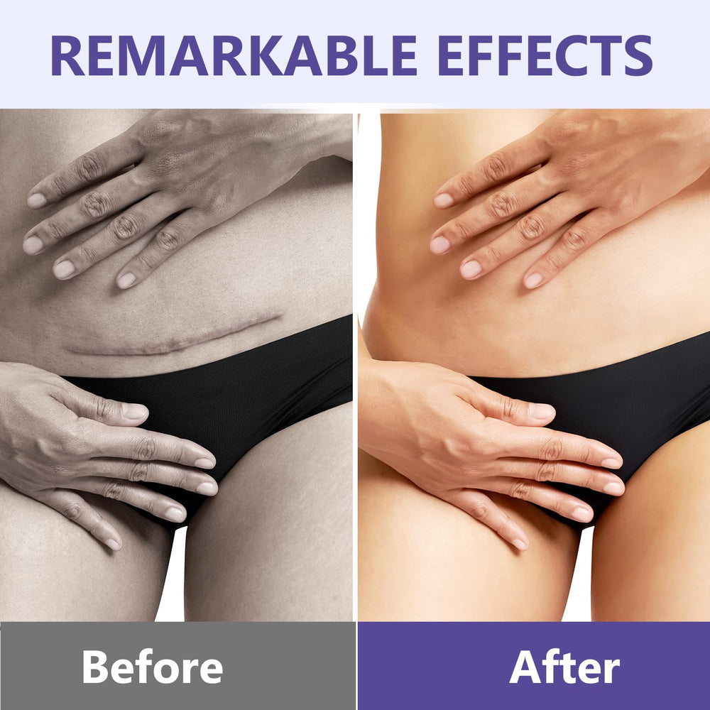 Hemir Keloid Bump Removal Cream before-after montage suggests texture improvement over time.