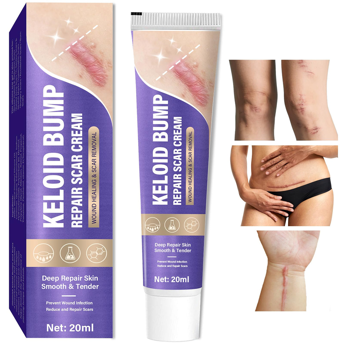 Hemir Keloid Bump Removal Cream packaging for daily at-home scar care.