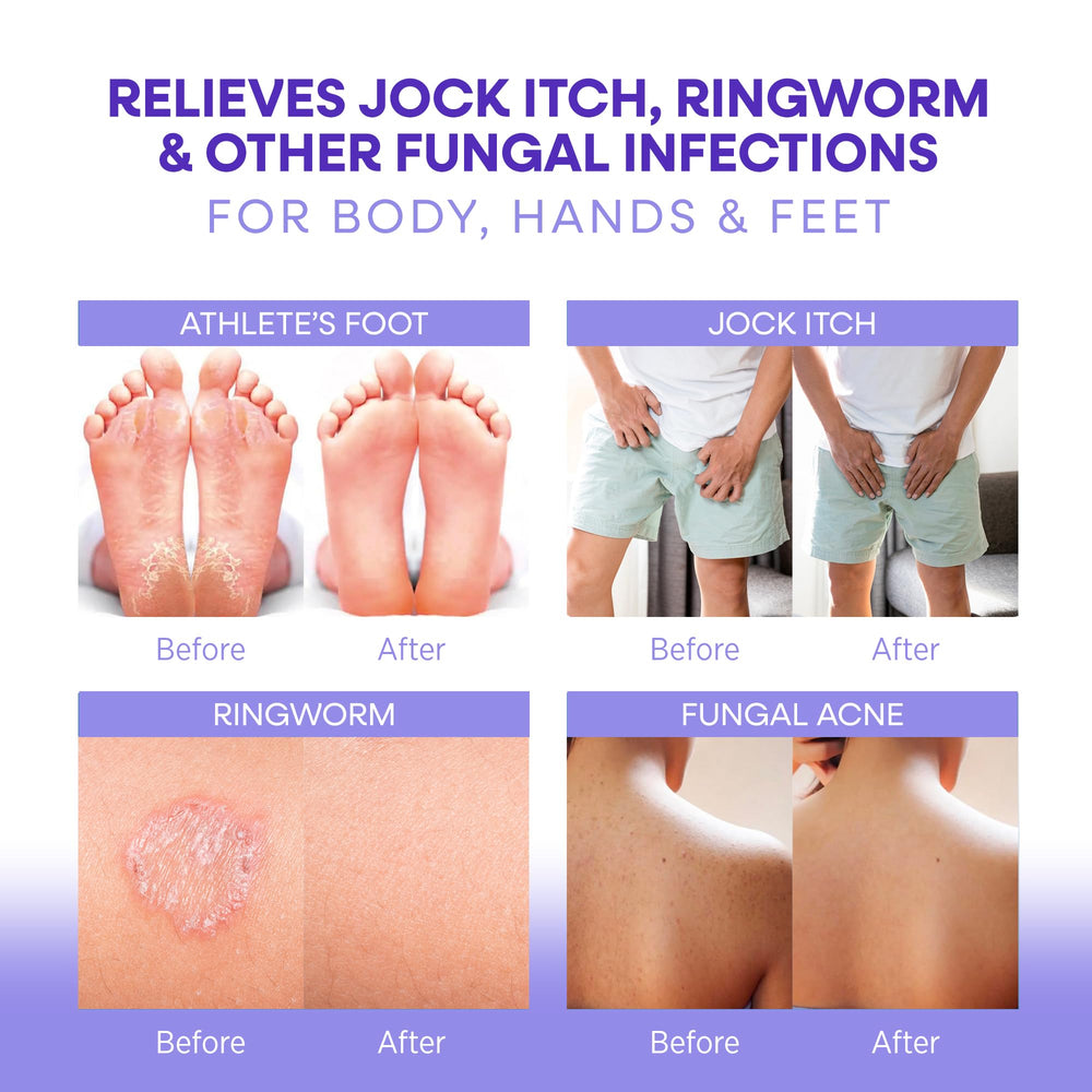 Hermon Antifungal Soap after-workout cleansing for feet and toes.