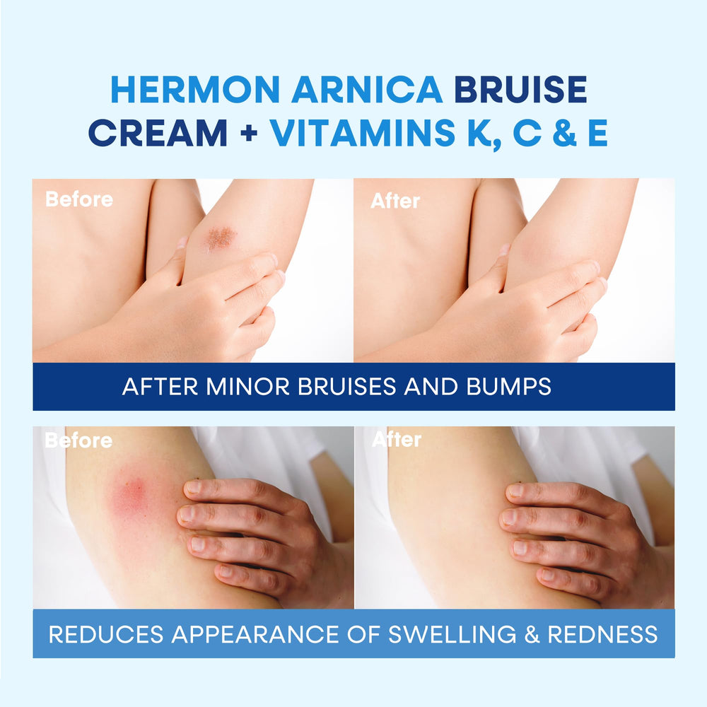 Hermon Arnica Bruise Cream hydration rich emphasizes coconut oil and shea butter comfort.
