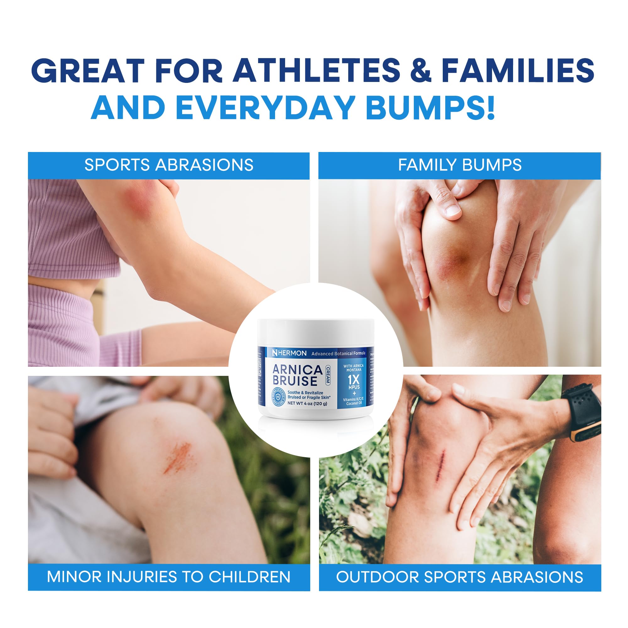 Hermon Arnica Cream applied to arm highlighting bruise-prone skin care.