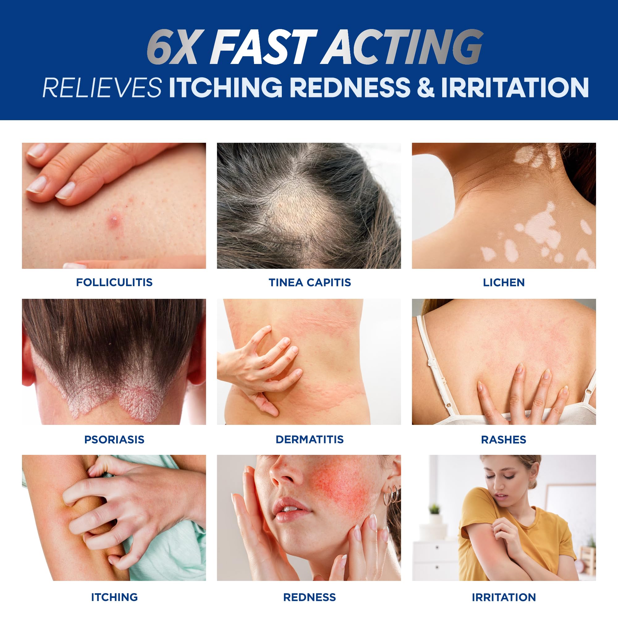 Hermon Folliculitis Cream applied to the face provides soothing care for sensitive skin