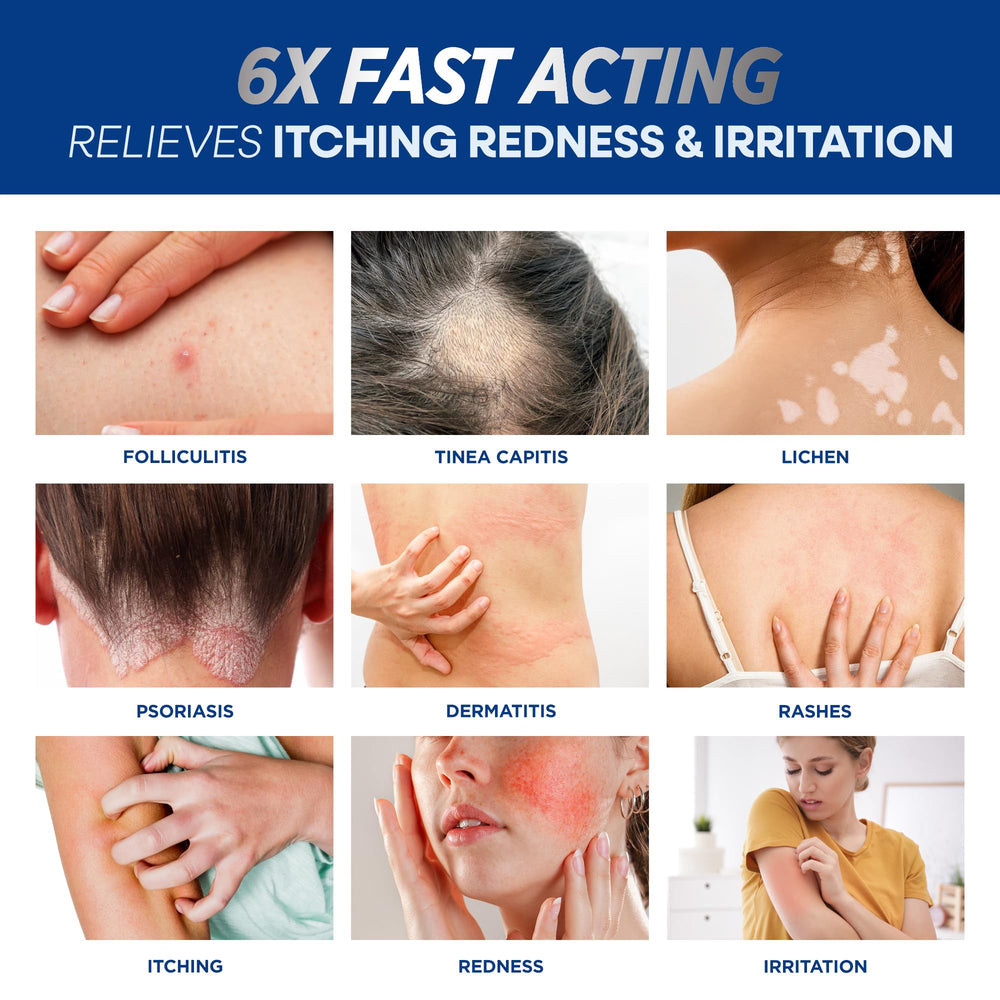 Hermon Folliculitis Cream applied to the face provides soothing care for sensitive skin
