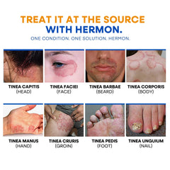 Hermon Ringworm Soap coconut-oil-drops showcases nourishing wash during fungal care.