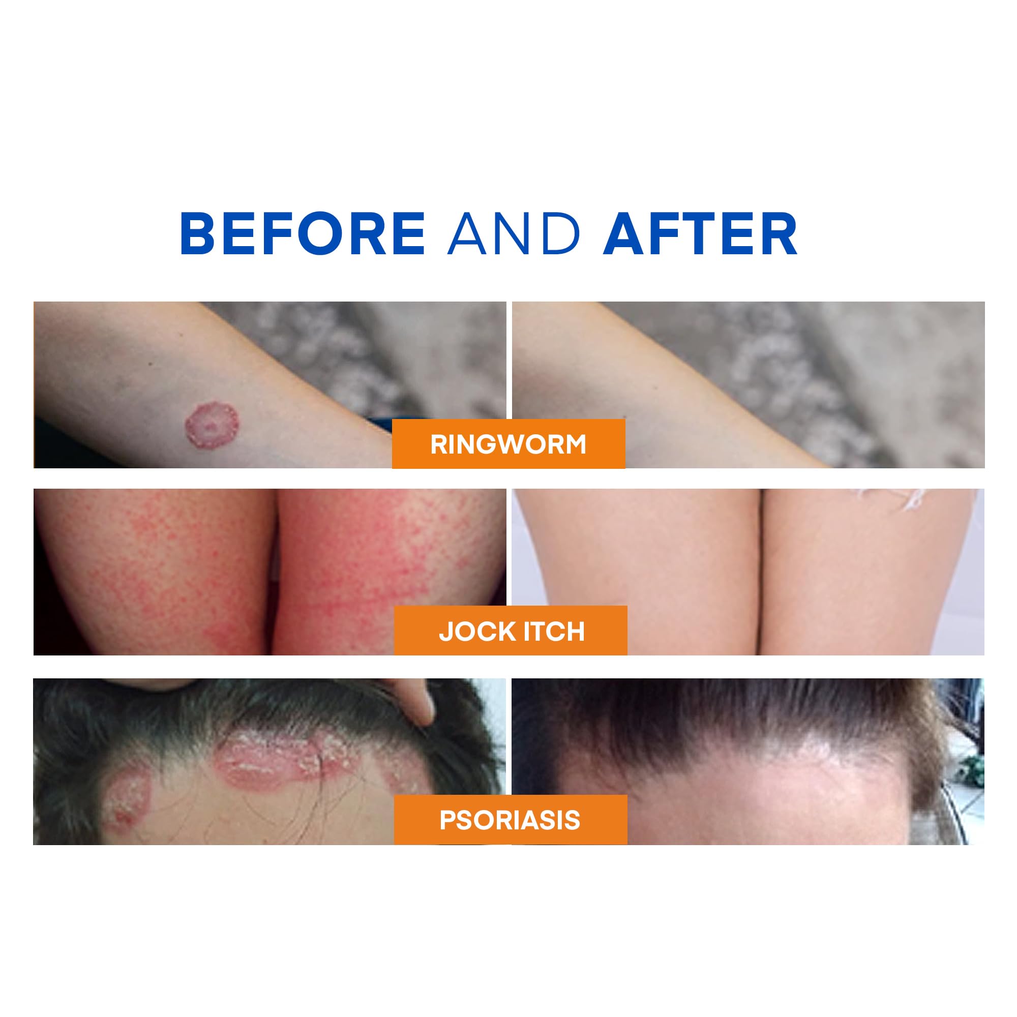 Hermon Ringworm Soap sulfur-thermal-water-foam provides deep cleansing action.