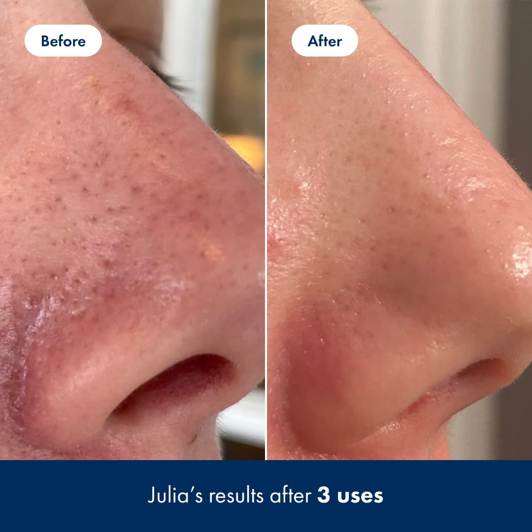 Hero Cosmetics Pore Release on the T-zone image suggests targeted pore care.