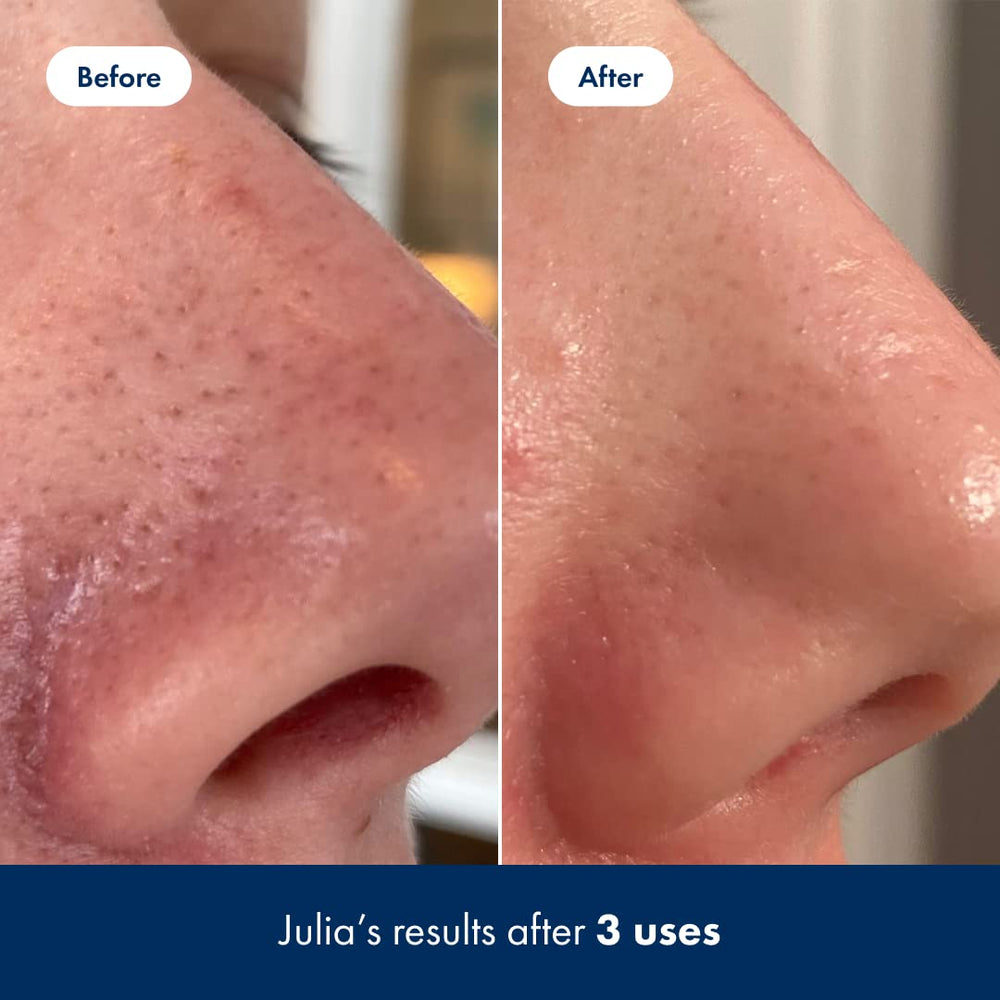 Hero Cosmetics Pore Release on the T-zone image suggests targeted pore care.