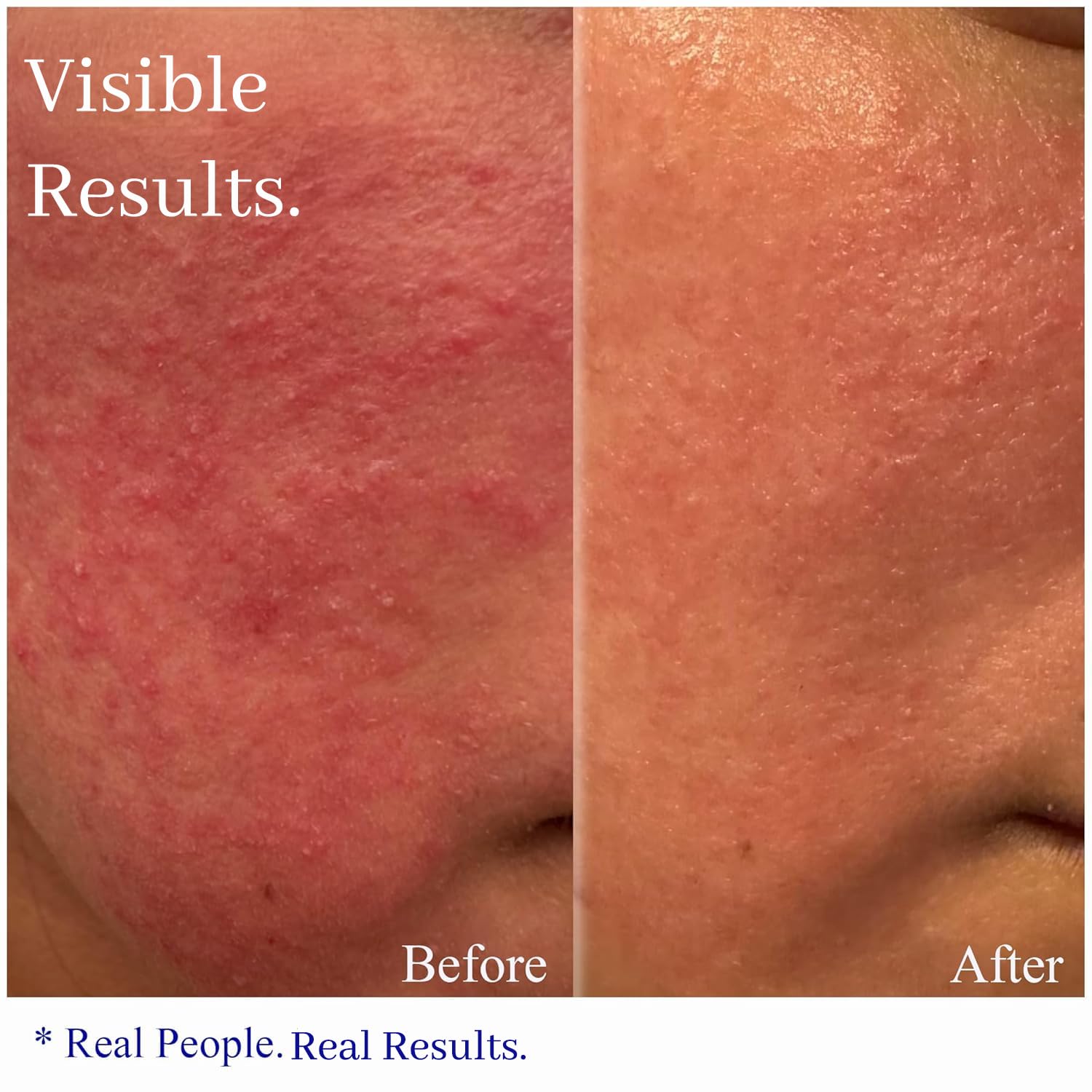 Hey Honey Skincare Relax jar application demonstrates quick absorption for rosacea-prone complexions.
