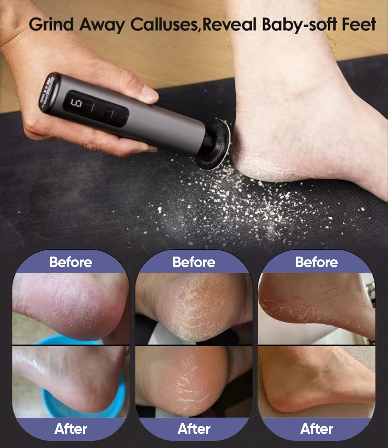 HILUDEER 12000rpm motor foot callus remover for quick dead skin reduction