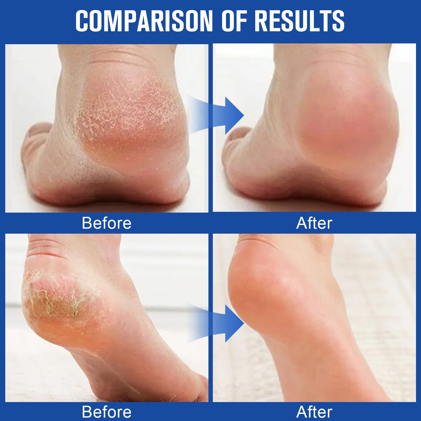 Holyarm Hand and Elbow application improves softness.