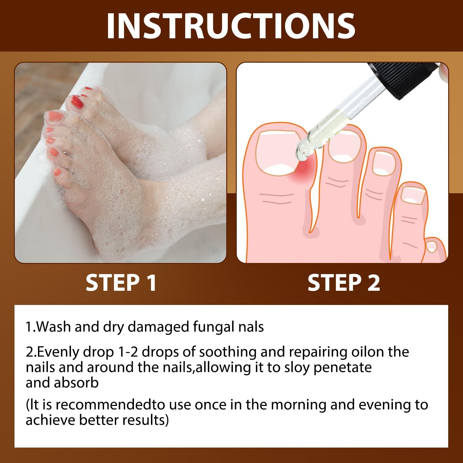 Iaolose paronychia embedded tissue reduction demonstrated during treatment.