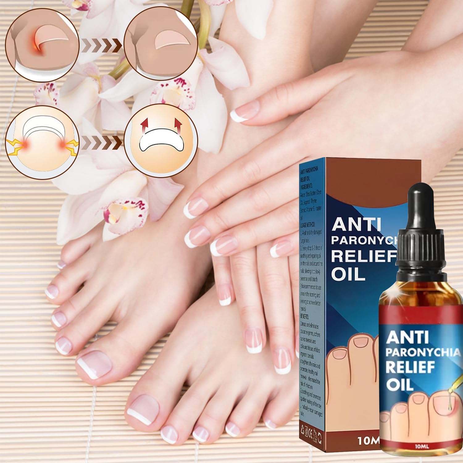 Iaolose paronychia nail discoloration repair in a home setting.