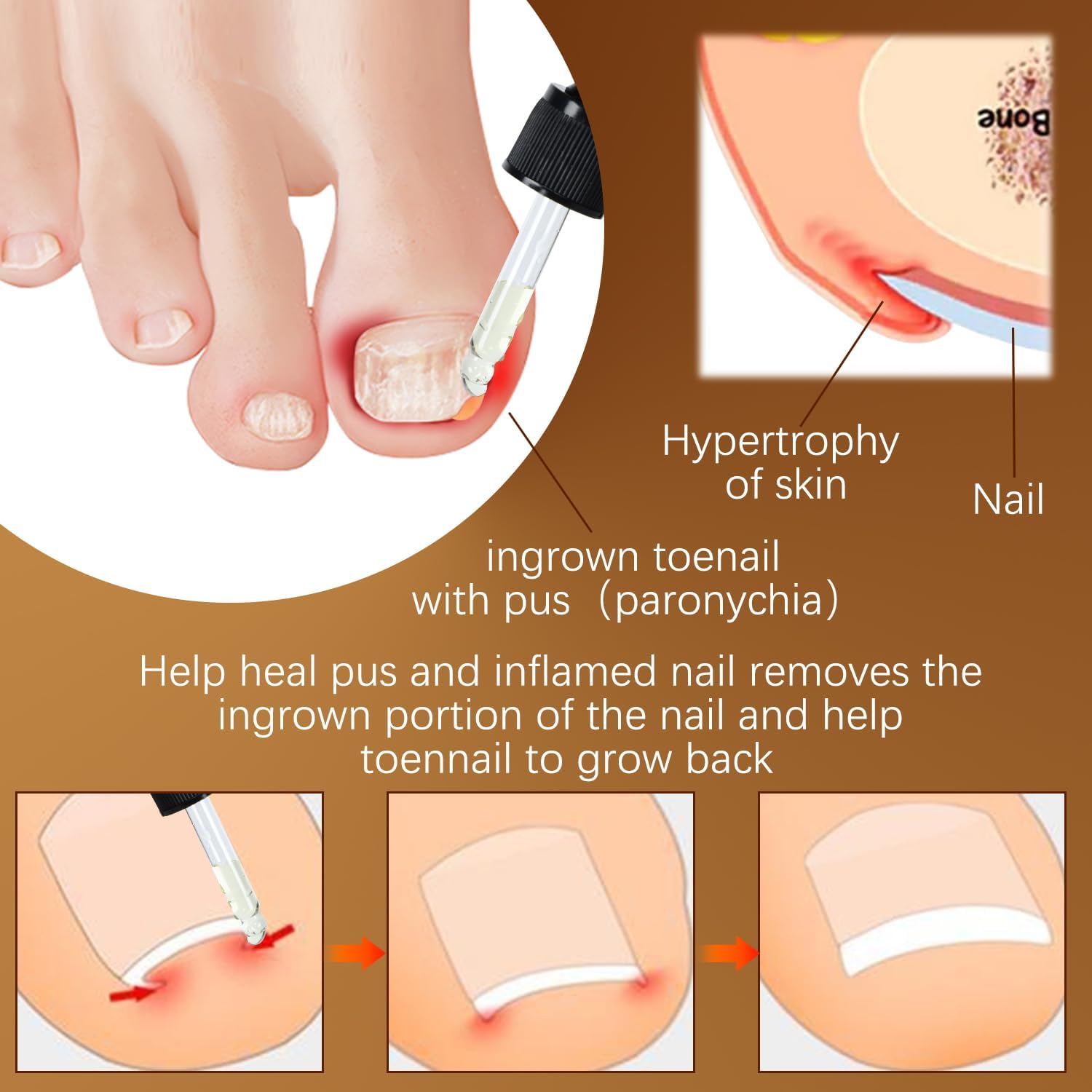 Iaolose paronychia nursing oil tube closeup emphasizes natural actives.