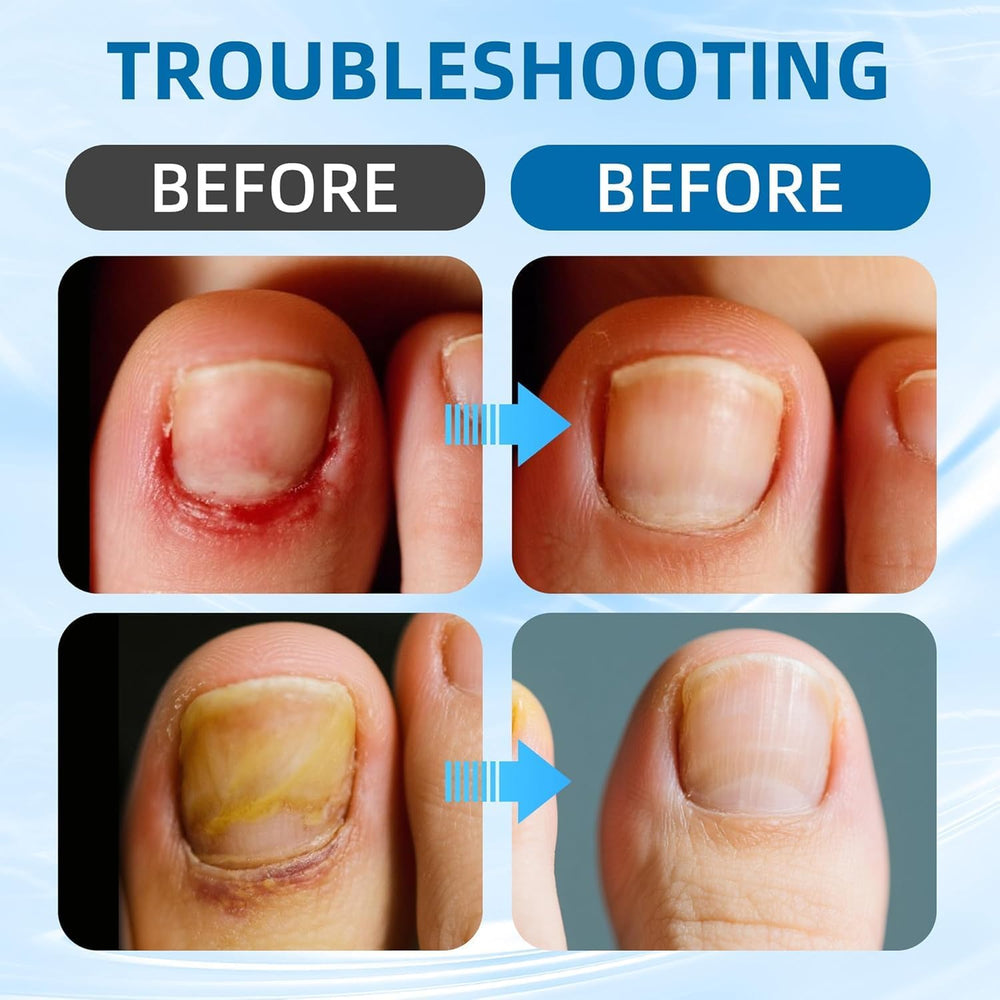 Ingrown Toenail Corrector Set soft-material patches reduce irritation during wear.