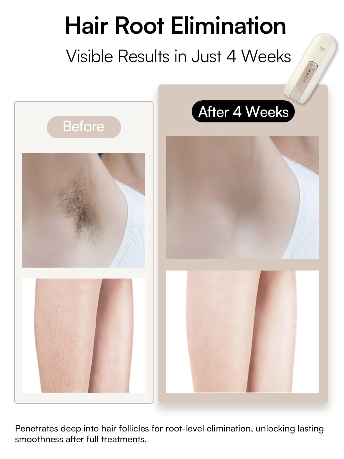INIA Fond face treatment demonstrated for gentle facial hair reduction