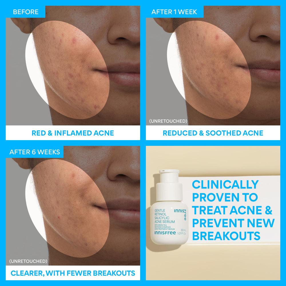 Innisfree bottle on white background suggests clean, everyday acne care.
