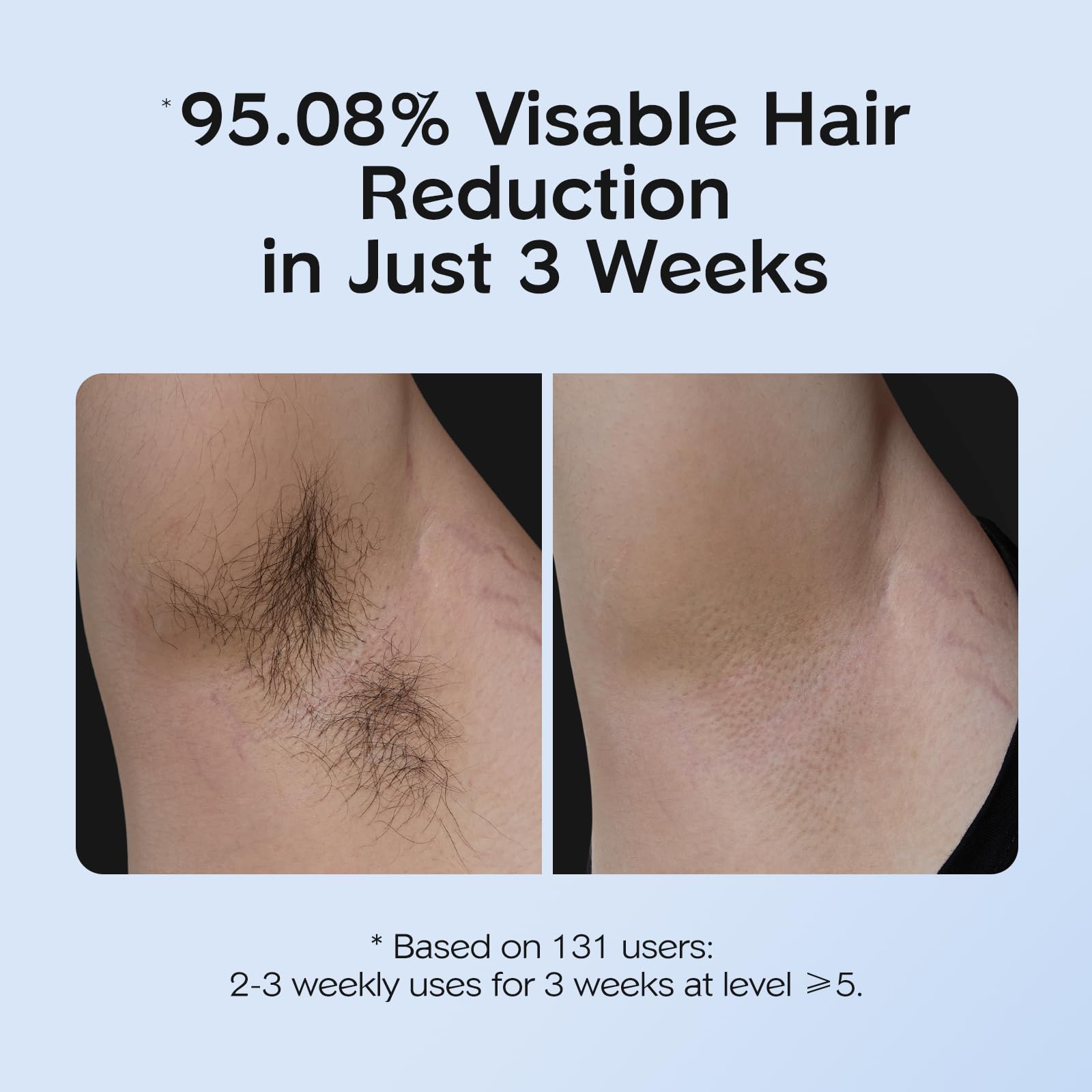 INNZA IPL 600nm, 5J/cm2 energy targets follicles more deeply