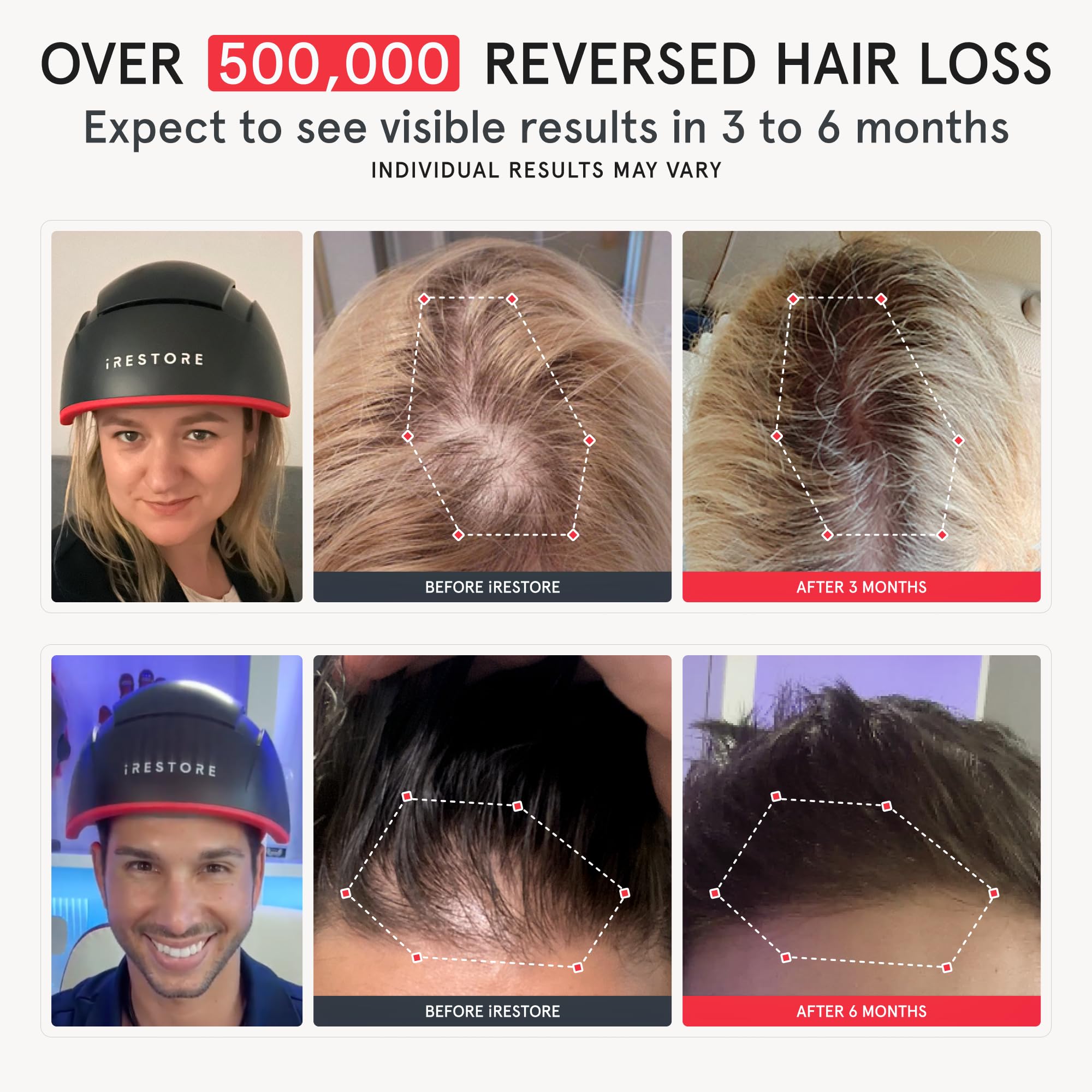 iRestore Elite internal laser array with 500 lasers and LEDs for potential hair growth