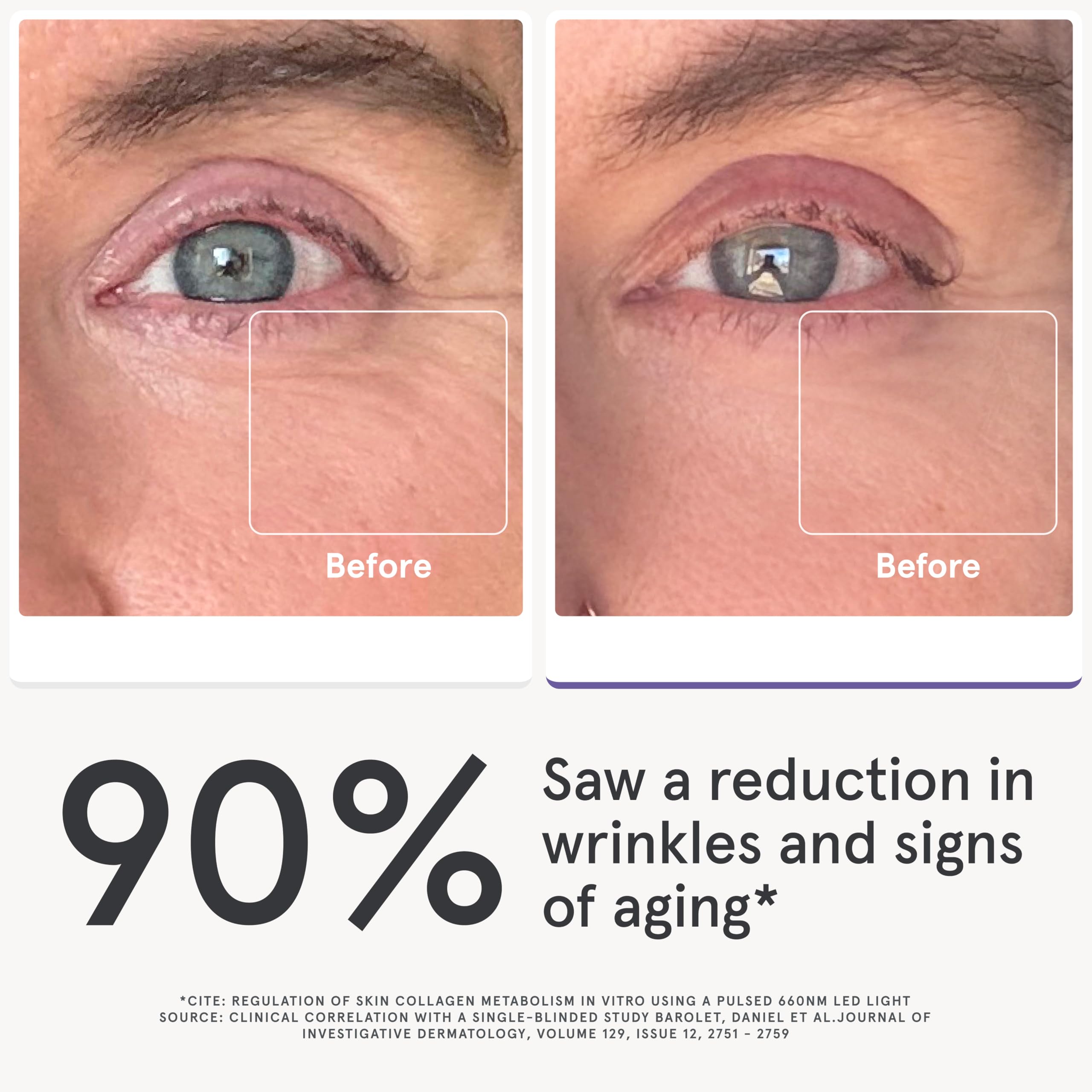 iRestore eye mask targets the under-eye area with red and infrared light therapy.