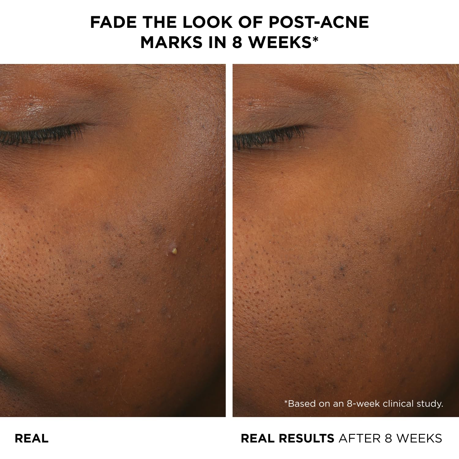 IT Cosmetics acne serum application pump demonstrates easy twice-daily routine