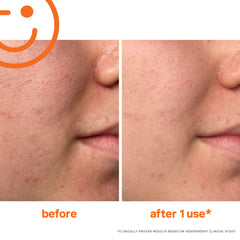Kate Somerville Exfolikate jar open ready for weekly glow boost.