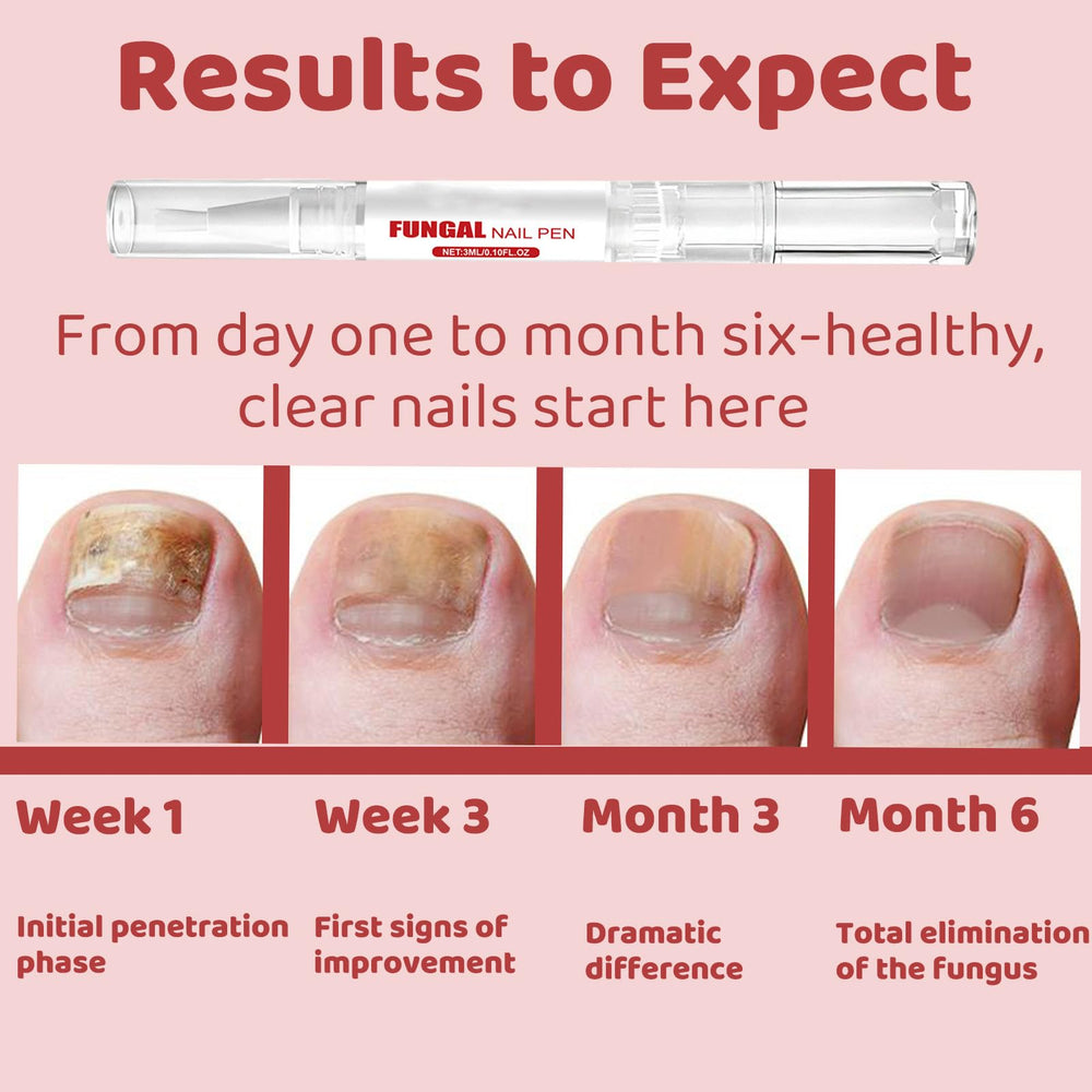 KBSBUBB fungal nail pen fast-dry formula for quick use