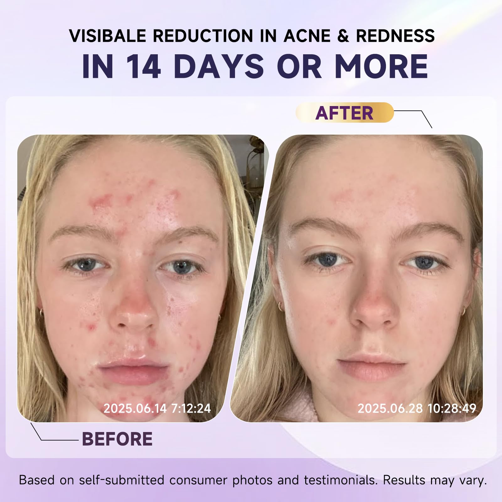 Kempc post-acne-marks-fade-visual illustrates fading marks and smoother complexion.