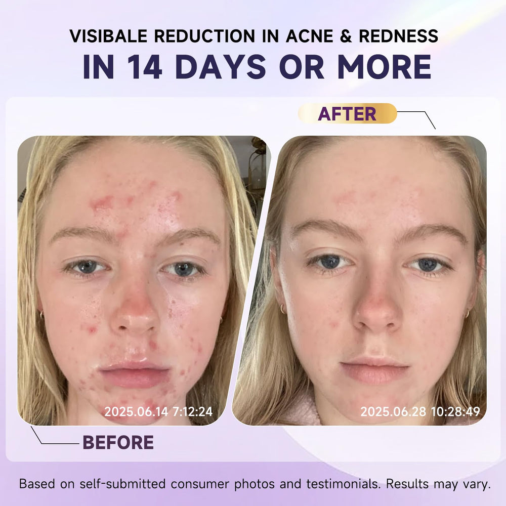 Kempc post-acne-marks-fade-visual illustrates fading marks and smoother complexion.