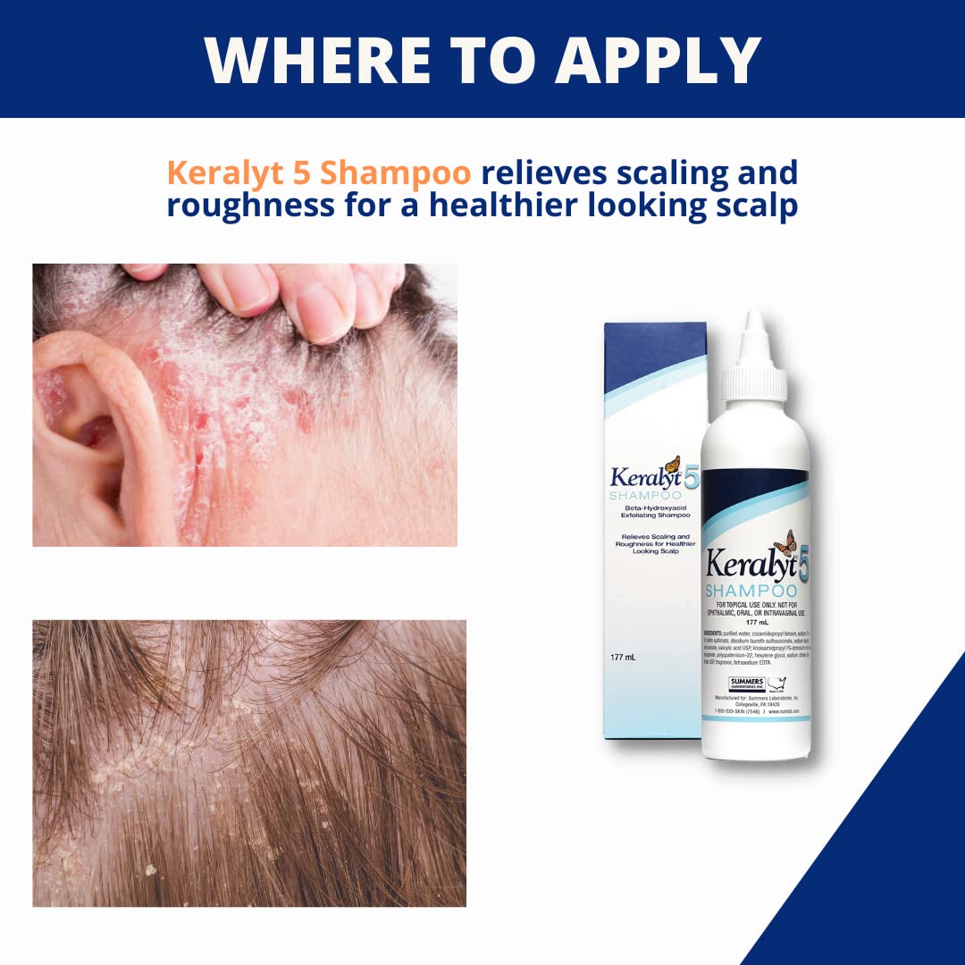 Keralyt 5 rich foam forming on scalp during wash.
