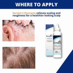 Keralyt 5 rich foam forming on scalp during wash.