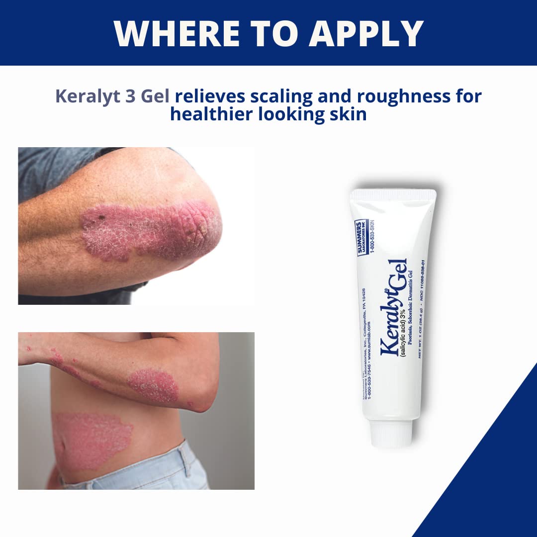 Keralyt application on hand – discreet care for sensitive spots.