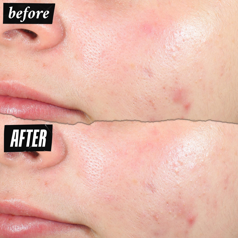 Kiehl's patch-transparent-spot on skin highlights subtle, invisible acne care.