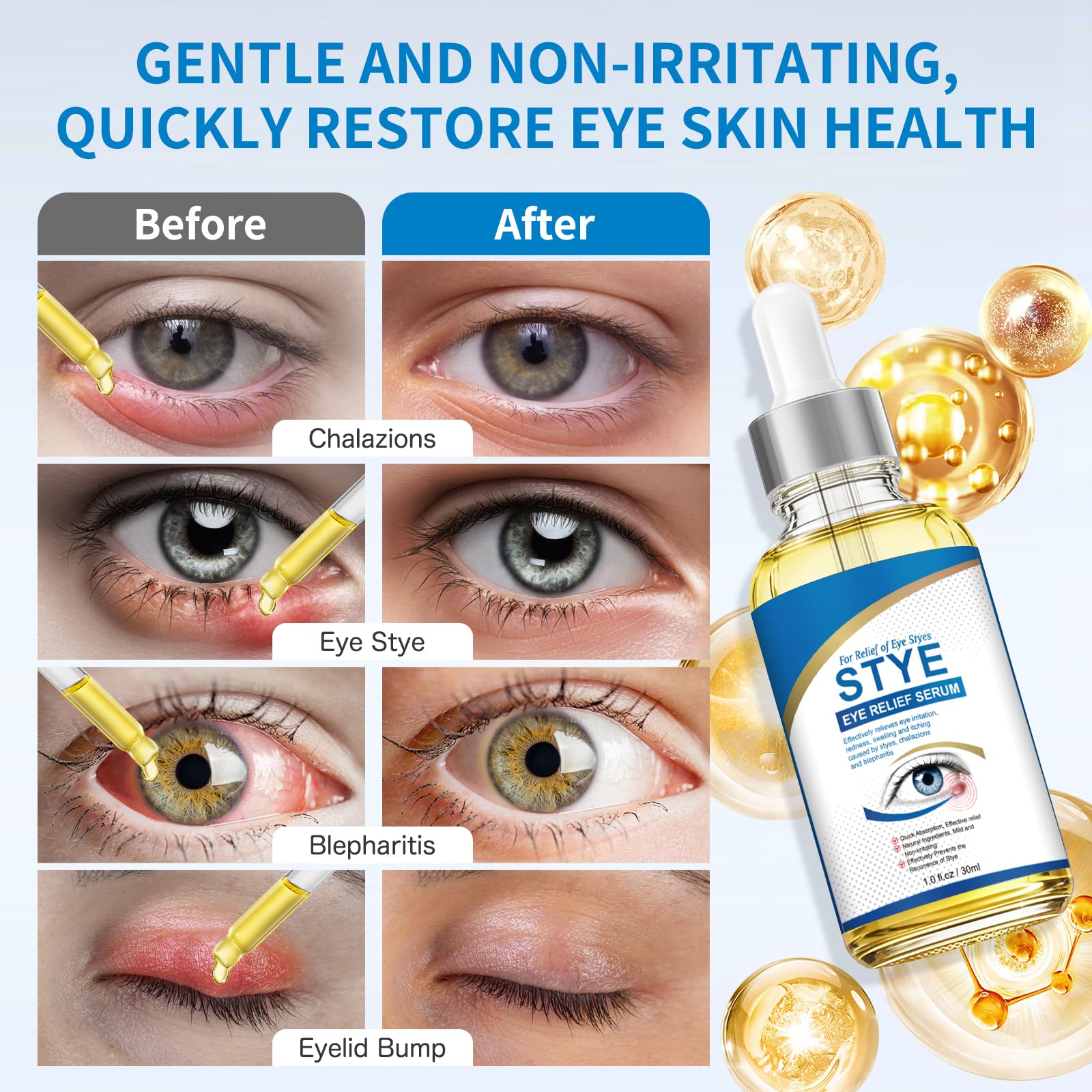 KODASNY Stye Eye Serum on eyelid demonstrates calm, comfortable eye area during flare-ups.