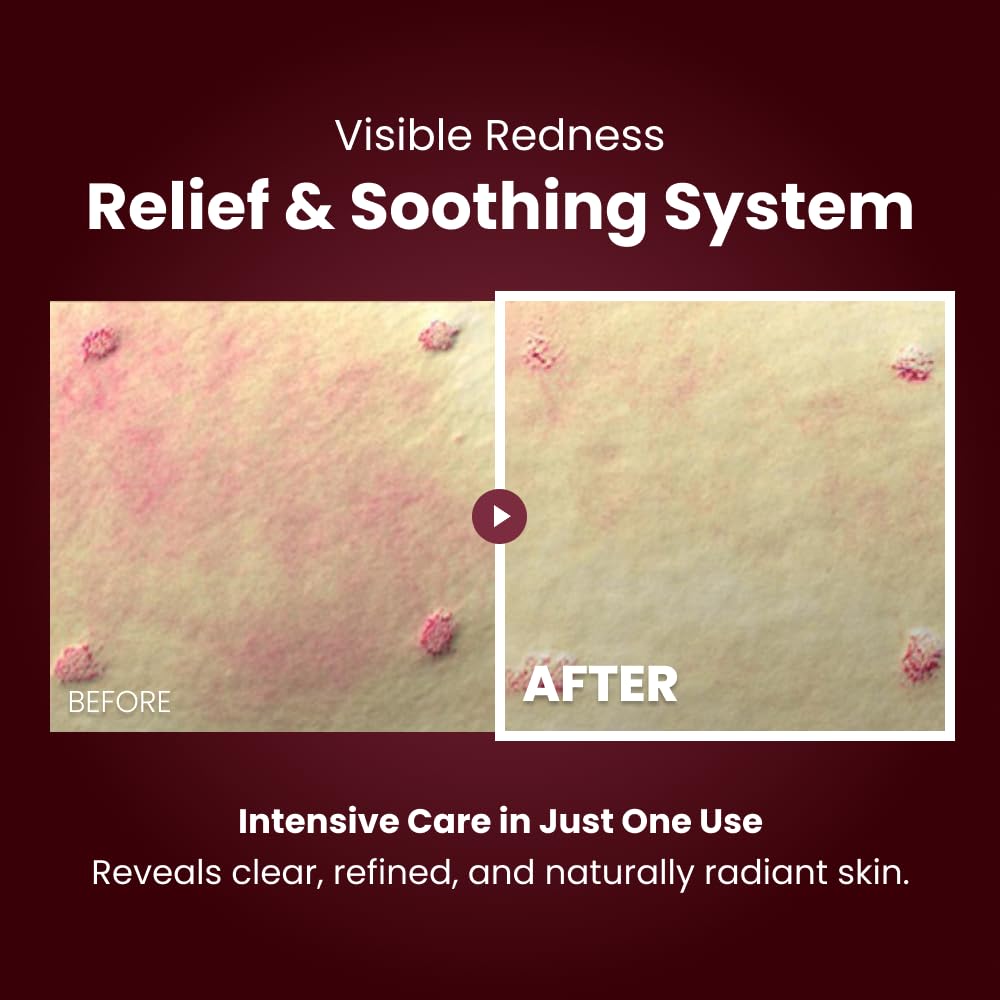 Kopher Curepair Melder SOS Cream being applied to calm irritated skin.