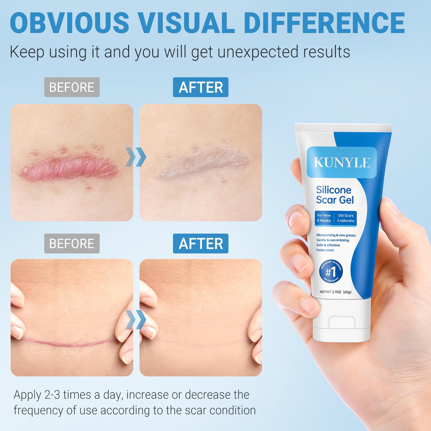 Kunyle silicone scar gel on scar area shows versatile use across body.