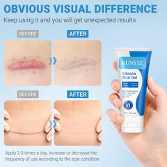 Kunyle silicone scar gel on scar area shows versatile use across body.